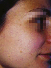 esiti da acne dopo il trattamento