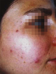 esiti da acne prima del trattamento