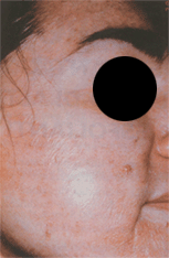 peeling e acido piruvico