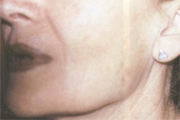 peeling e acido piruvico