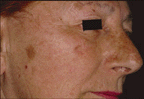 peeling a varie concentrazioni per trattare l'acne