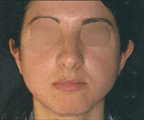 peeling a varie concentrazioni per trattare l'acne
